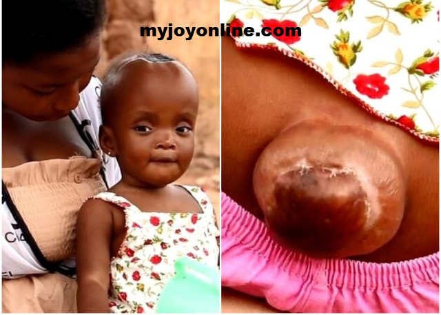Gyataba Saves Baby Girl With Obstructive Hydrocephalus Disease From Dying