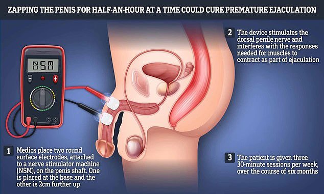 A look at how zapping the ‘penis’ could combat premature ejaculation